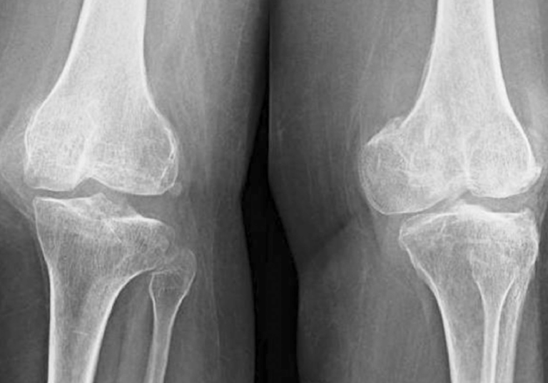 Остеофиты кости. Knee XRAY. Остеофит большеберцовой кости рентген. Остеофиты коленного сустава. Остеофиты коленного сустава рентген.